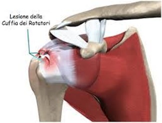 Immagine Dolore spalla