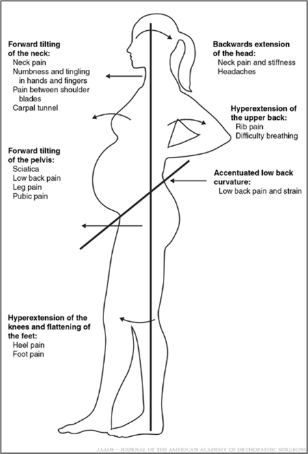 Immagine mal di schiena in gravidanza